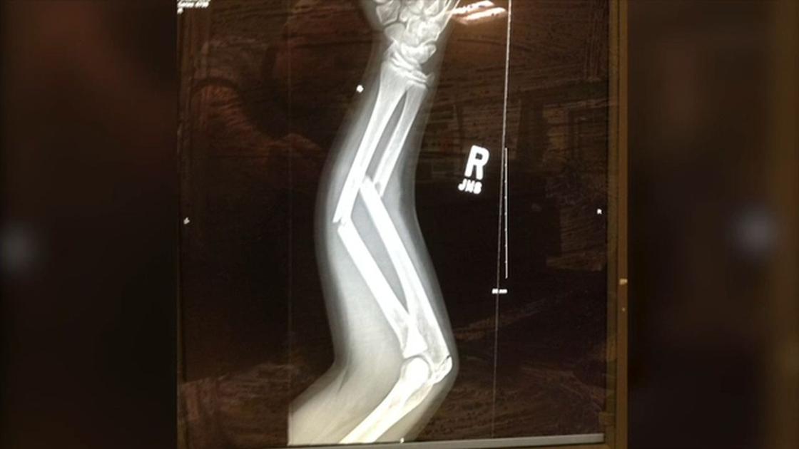 Health Beat 3d Imaging Ends 4 Years Of Fracture Pain Health Beat Wfmz Com
