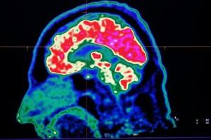 Final report casts doubt on existence of Canada mystery brain illness