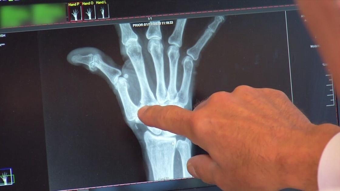 icd 10 code for right thumb cmc joint arthritis