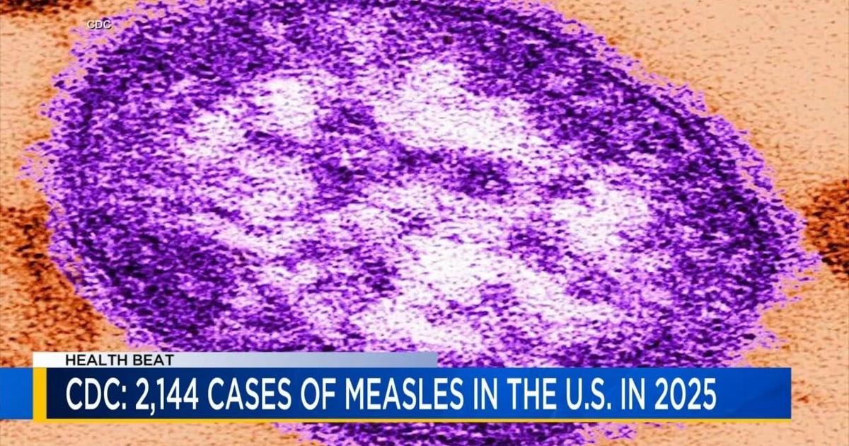 Health Beat: Measles on the rise in the U.S.