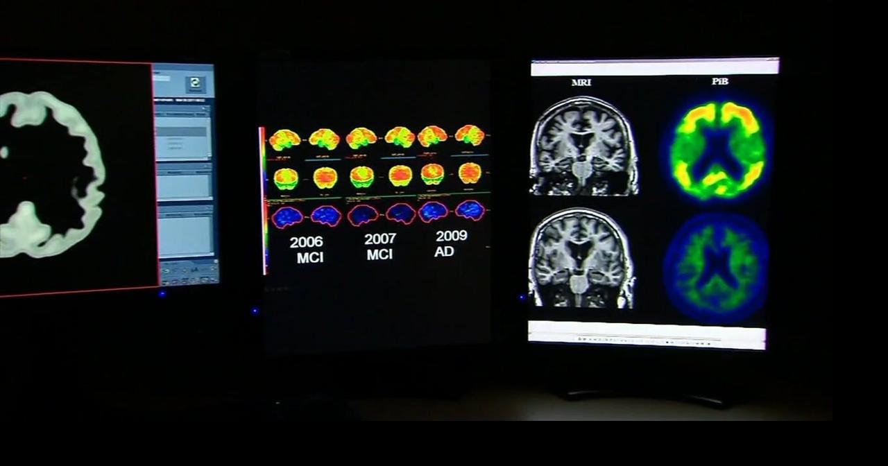 Health Beat: Researchers call new stroke prevention drug a ‘gamechanger’