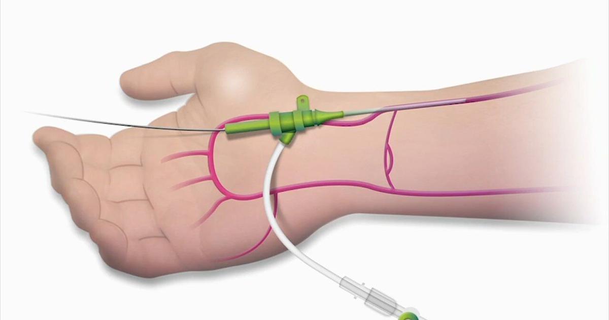 Health Beat: From your hand to your heart: New catheter techniques saving lives