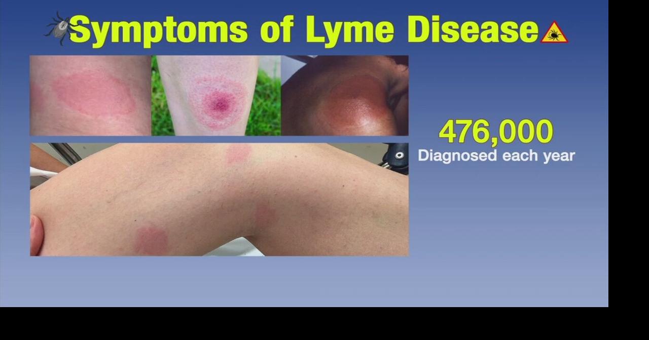 Ticked Off What You Need To Know About Lyme Disease Life Lessons