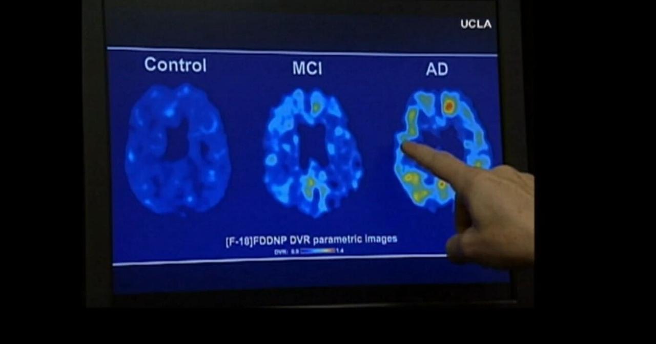 Health Beat: Footballs impact on players health revealed in new study