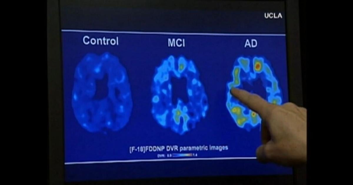 Health Beat: Footballs impact on players health revealed in new study