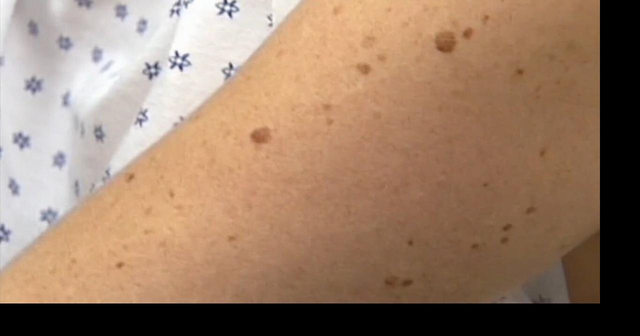 Health Beat: Melanoma warning signs