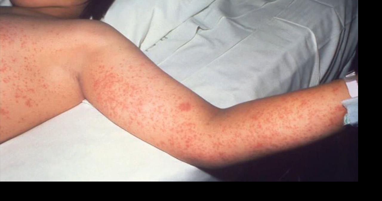 Health Beat: CDC investigates deadly measles outbreak in Pennsylvania