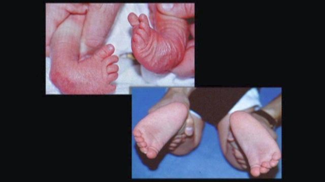 Health Beat Clubfoot Most Common Birth Defect You Ve Never Heard Of Health Wfmz Com