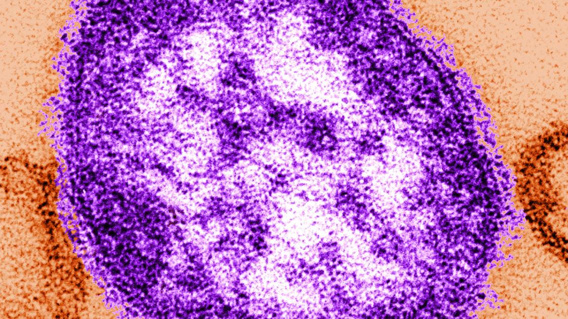 Pa. Dept. of Health: Residents who visited locations in Allentown may have been exposed to measles - WFMZ Allentown thumbnail