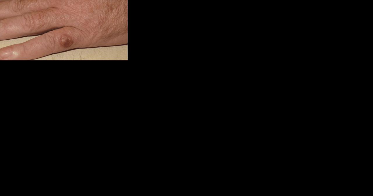 Health Beat: The rare skin cancer that killed Jimmy Buffett - Vimarsana News