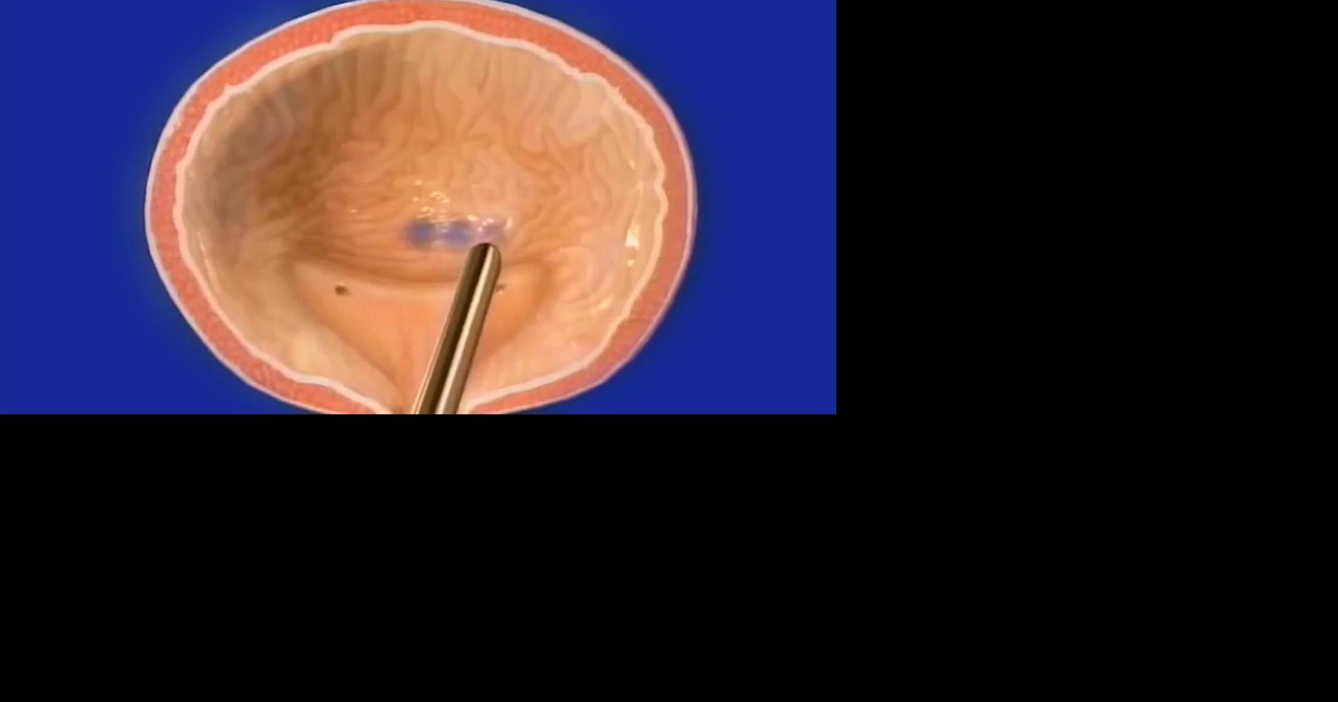 Health Beat: Botox for the bladder | Health | wfmz.com