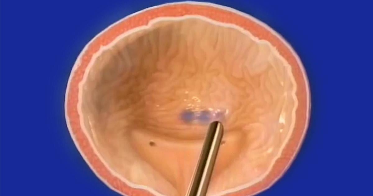 Bladder Botox Instrument Health Beat: Botox for the bladder | Health | wfmz.com