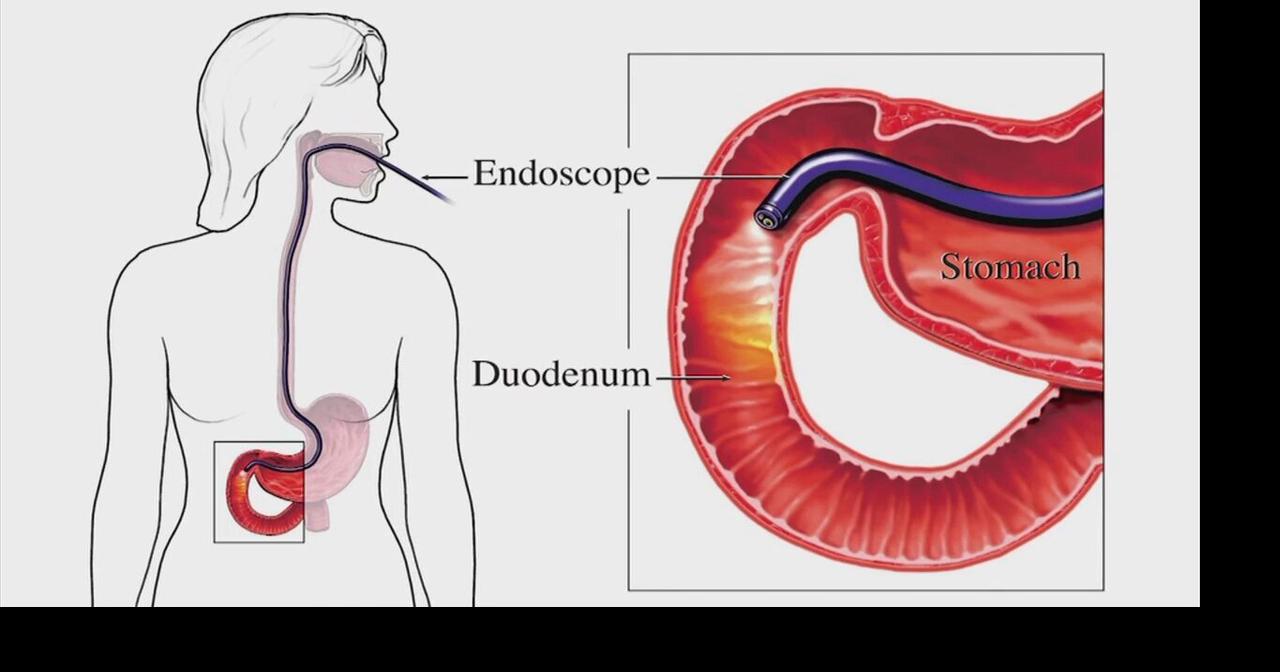 Endoscopy: benefits of the scope | Health | wfmz.com