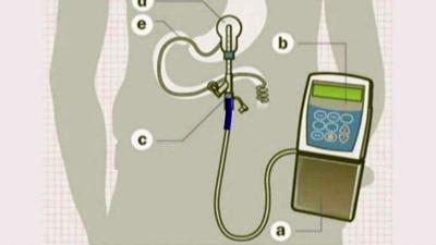 Health Beat: DUOPA for Parkinson's patients | Health | wfmz.com
