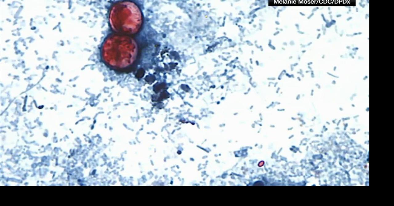 Stomach parasite cases spike in 18 states; doctors urge caution with produce