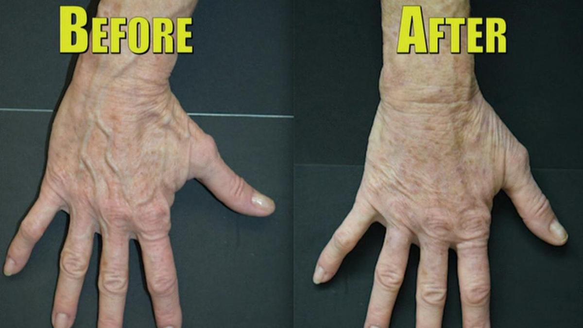 Health Beat Fix Bulging Veins To Rejuvenate Your Hands Health Wfmz Com