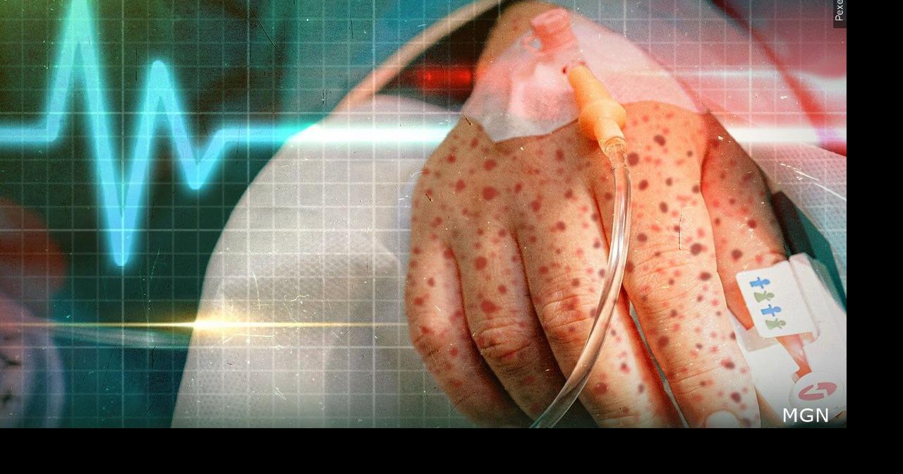 Public health officials announced no additional reports of measles associated with Feb. 2 case