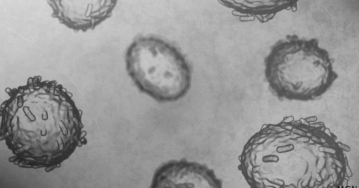 Wisconsin DHS confirms 5 mpox cases