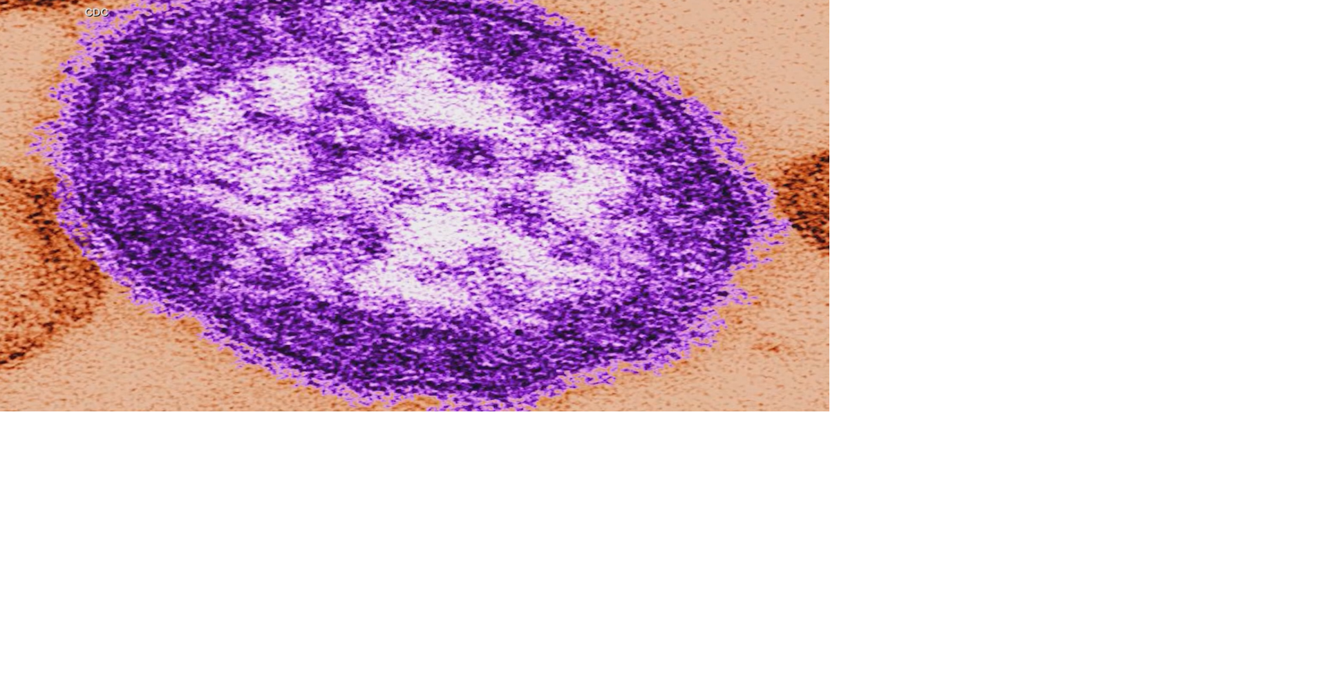 Wisconsin DHS scrambling to tackle measles outbreak