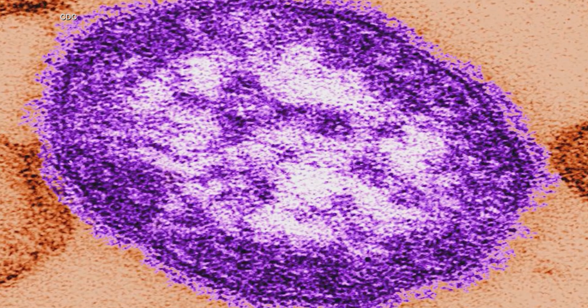 Wisconsin DHS scrambling to tackle measles outbreak