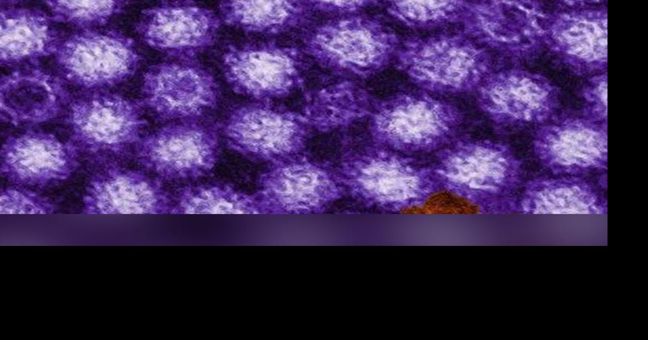 Health officials see rise in norovirus cases News