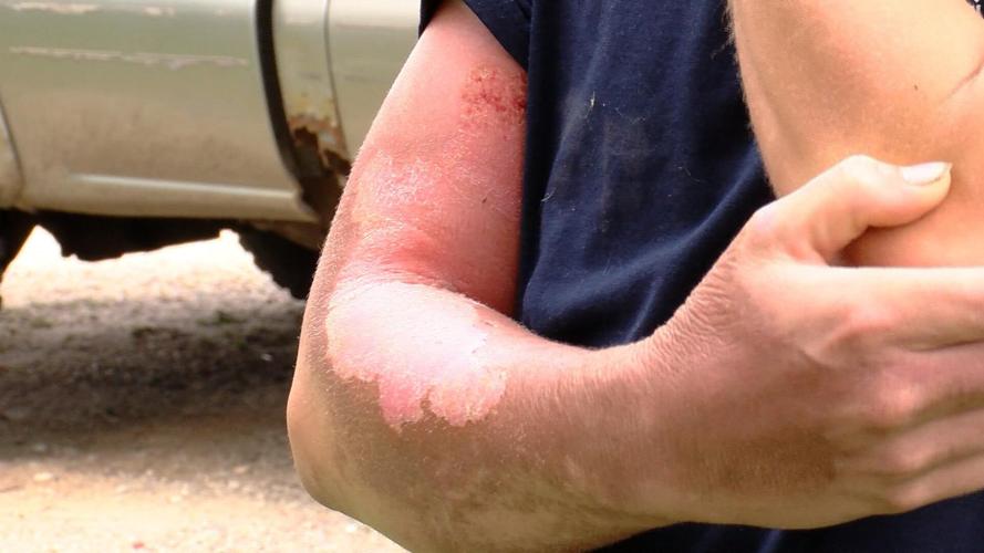 Firefighter Rashes 'All of a sudden it exploded'; Baraboo Firefighter severely burned in ...
