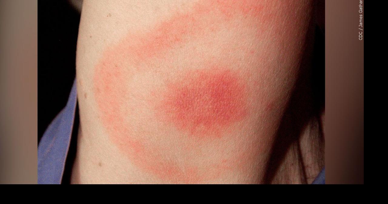 Lyme disease cases rising in Wisconsin how you can avoid infection