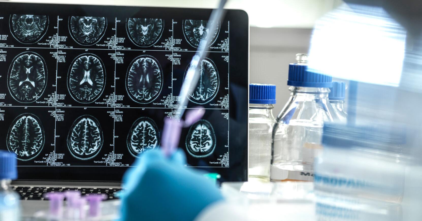 Experimental drug appears to slow progression of Alzheimer's disease in clinical trial but raises safety concerns - Vimarsana News
