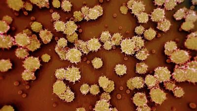 Biden administration declares the monkeypox outbreak a public health emergency