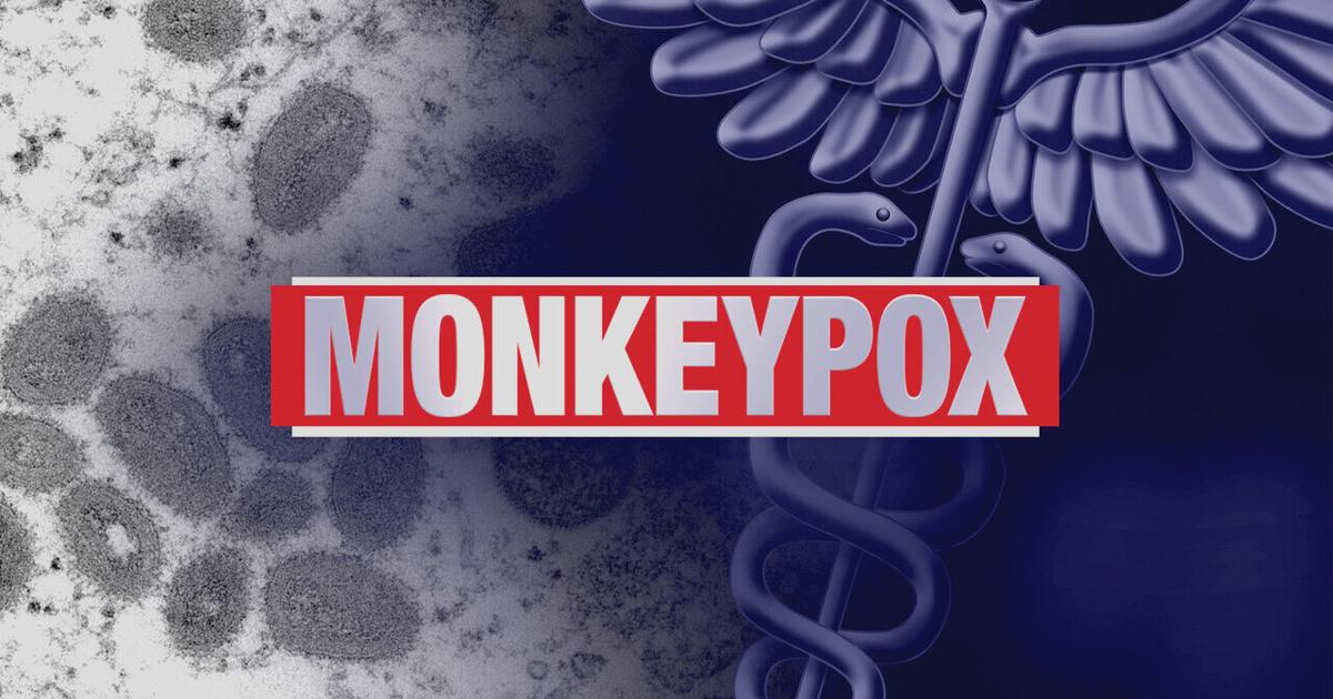 Oneida County reports first case of monkey pox |  Health