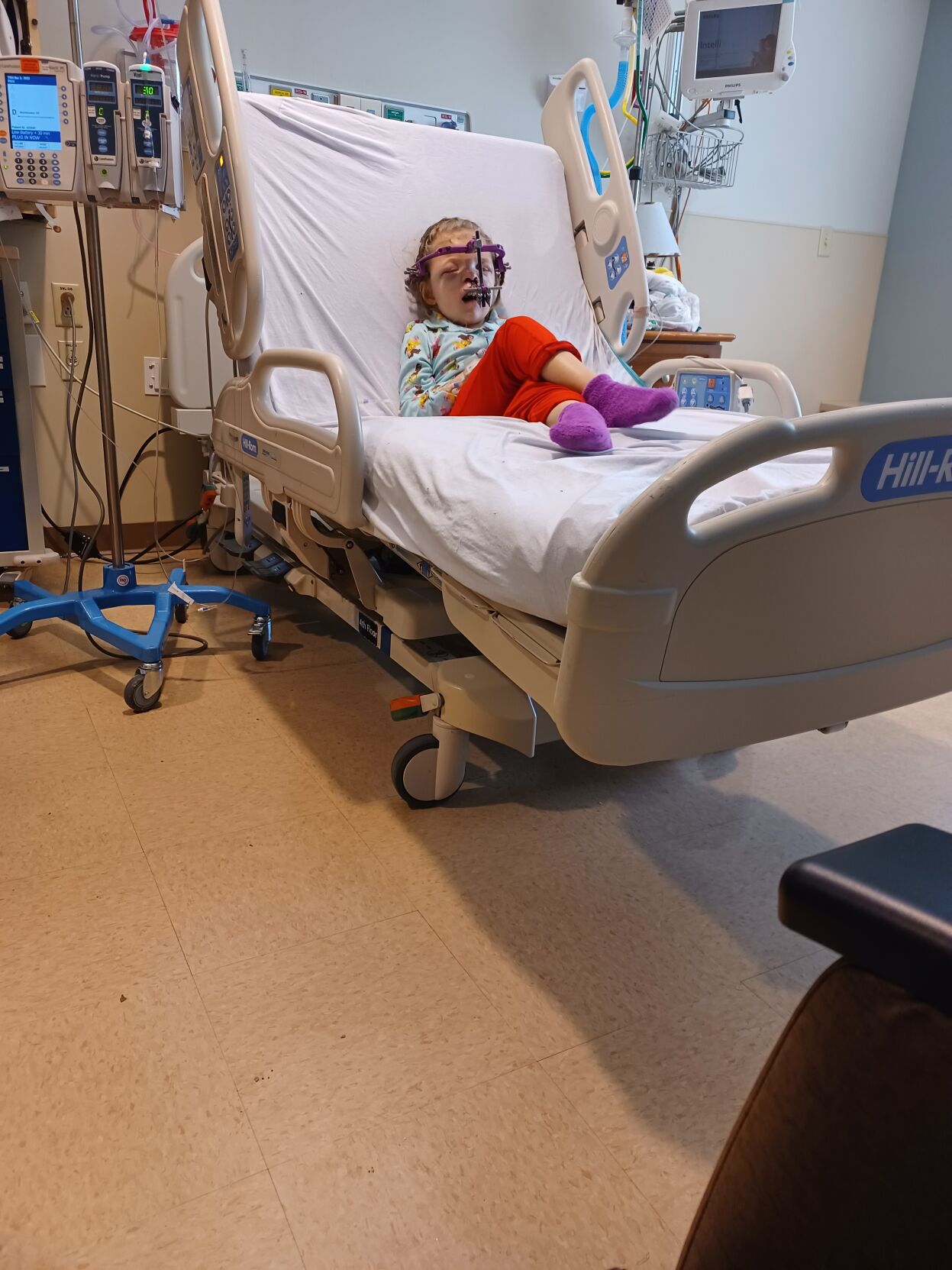 Wickliffe girl with Apert Syndrome conquers 25th surgery | News | WPSD ...