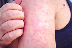Kentucky Reports Reaching 100 Measles Cases