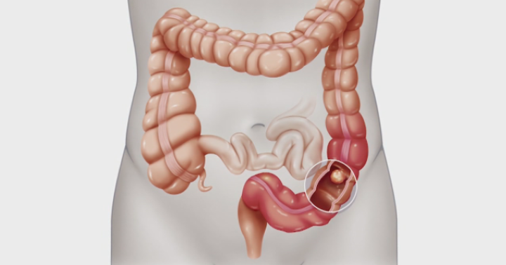 Getting to the Bottom of Better Health: CHESI to Host Colorectal Cancer Awareness Event