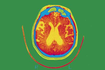 Experimental therapy gantenerumab fails to slow or improve Alzheimer's memory loss in clinical trials