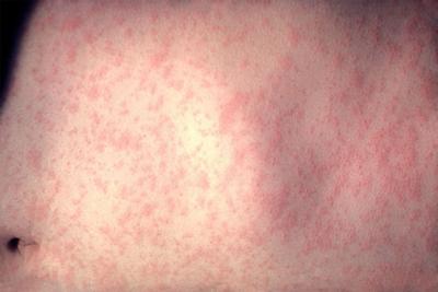 Measles outbreak involving cases at a Philadelphia day care center expands, health officials say