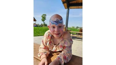 Walk to build community for people with alopecia areata