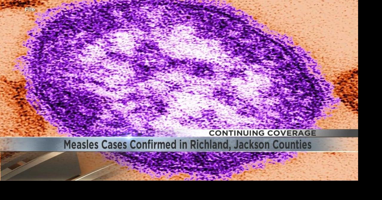 Measles spreads to Richland County as officials warn of exposure risk ...