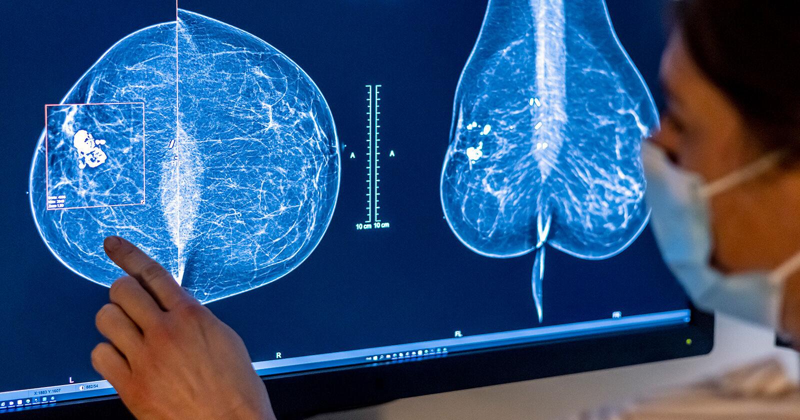 Breast density changes over time could be linked to breast cancer risk, study finds - Vimarsana News