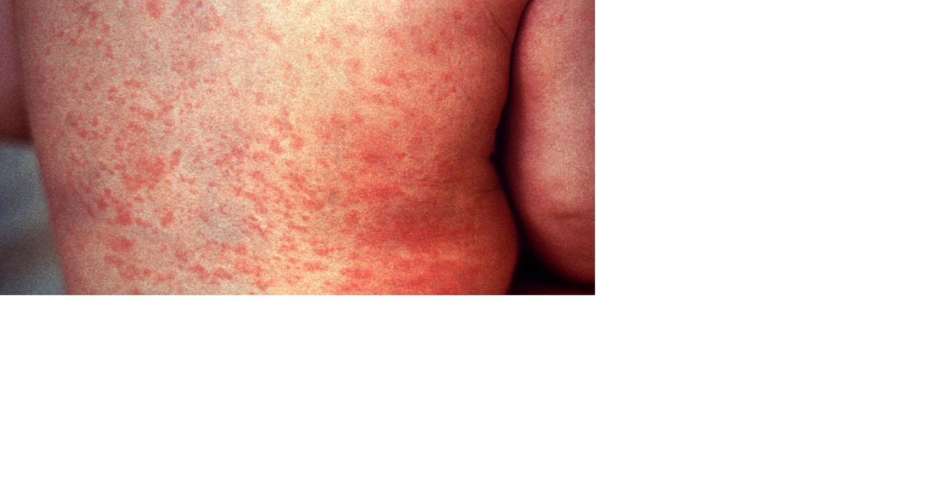 La Crosse County health officials on alert as Wisconsin measles cases hit 110