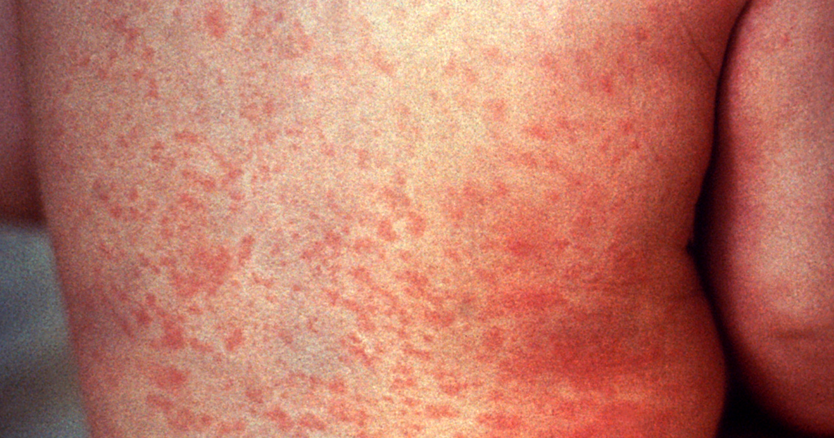 La Crosse County health officials on alert as Wisconsin measles cases hit 110