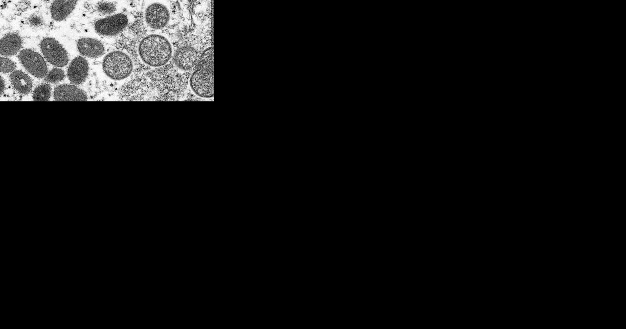 DHS identifies first case of monkeypox in Wisconsin, risk remains low - Vimarsana News