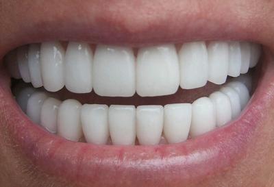 Study Finds No Drill Techniques Can Treat Tooth Decay Just As Well As Fillings Health Yakimaherald Com