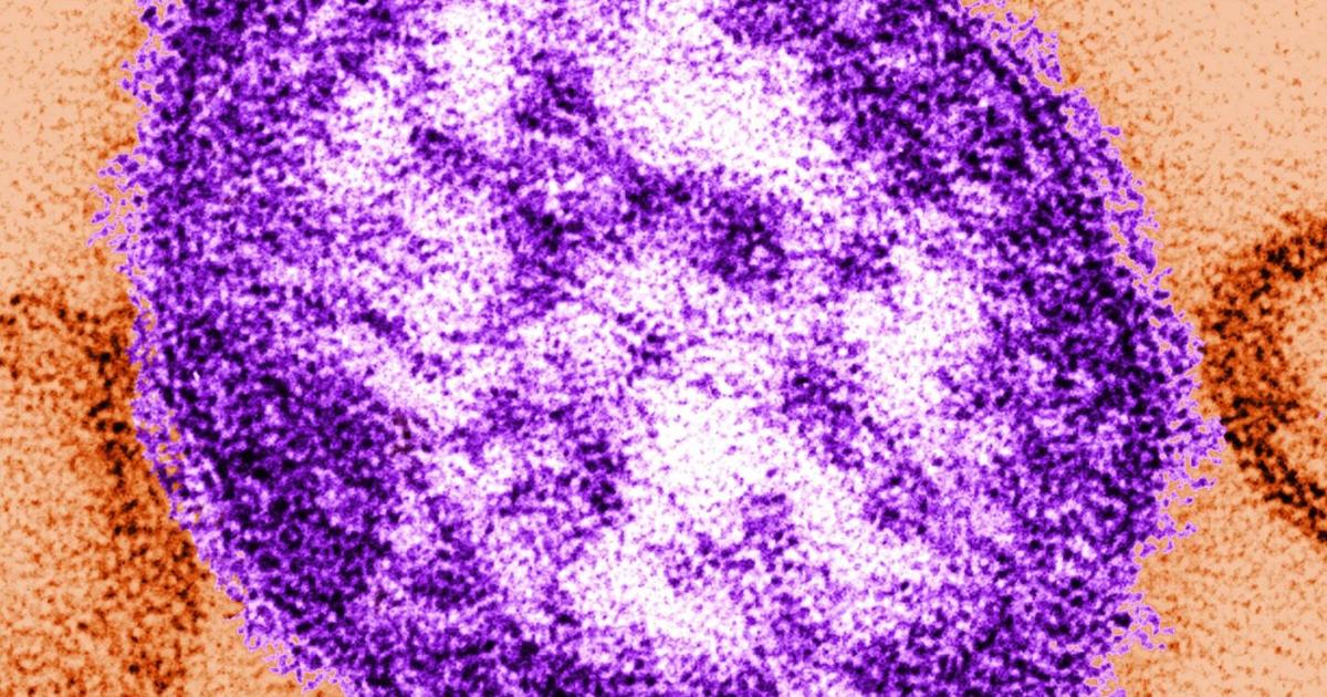 Patient with measles was at MultiCare hospital in Yakima on July 13