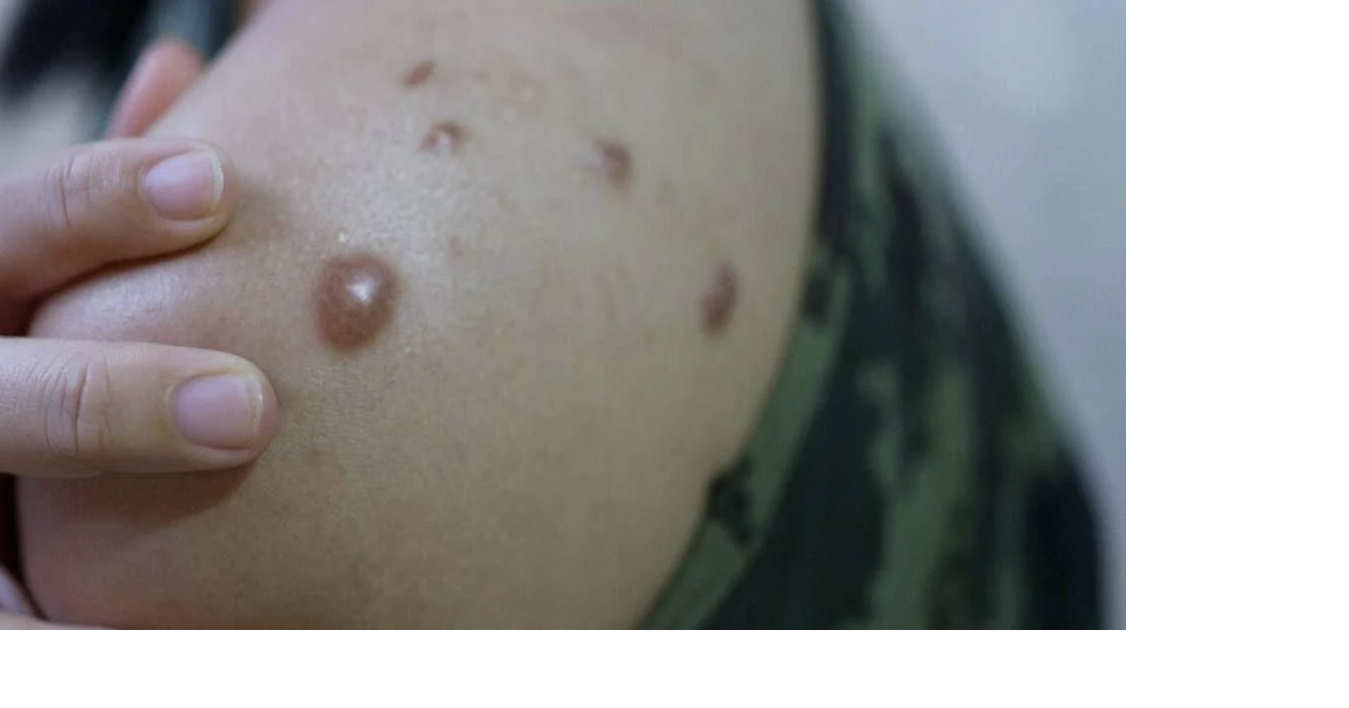 Viruela del mono confirmada en el condado de Kittitas ESPAÑOL