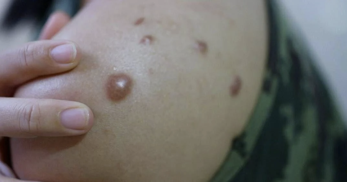 Viruela del mono confirmada en el condado de Kittitas ESPAÑOL