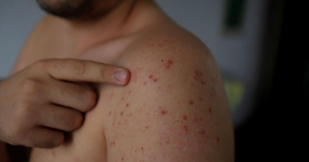 Kittitas County Reports Four Measles Cases in 2026 as Health Officials Urge Vaccinations