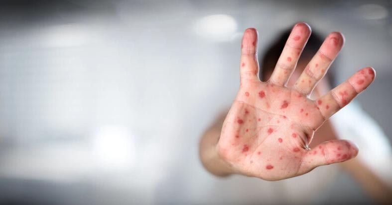 Confirmed Measles Case Reported in Kittitas County, Health Officials Monitoring Situation
