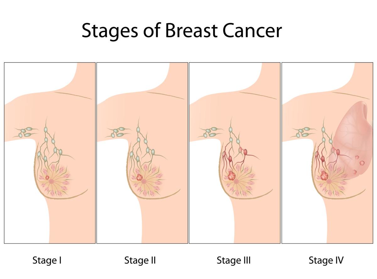 The stages of breast cancer | Feeling Fit | yoursun.com