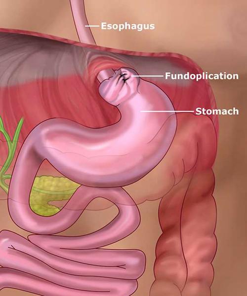 Managing Gerd A Florida Surgeon S Perspective Feeling Fit