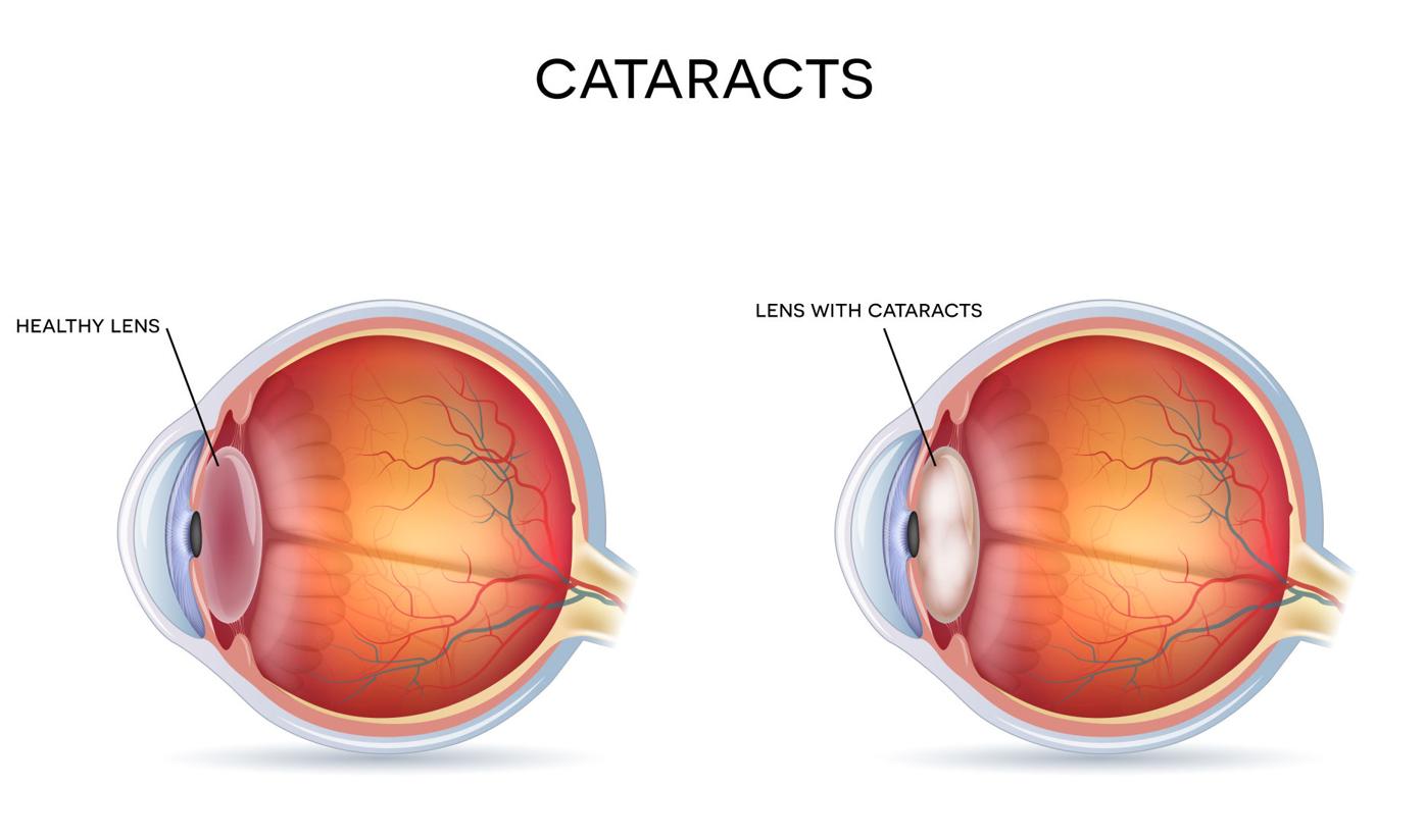 The Miracle Of Modern Cataract Surgery Feeling Fit Yoursun Com